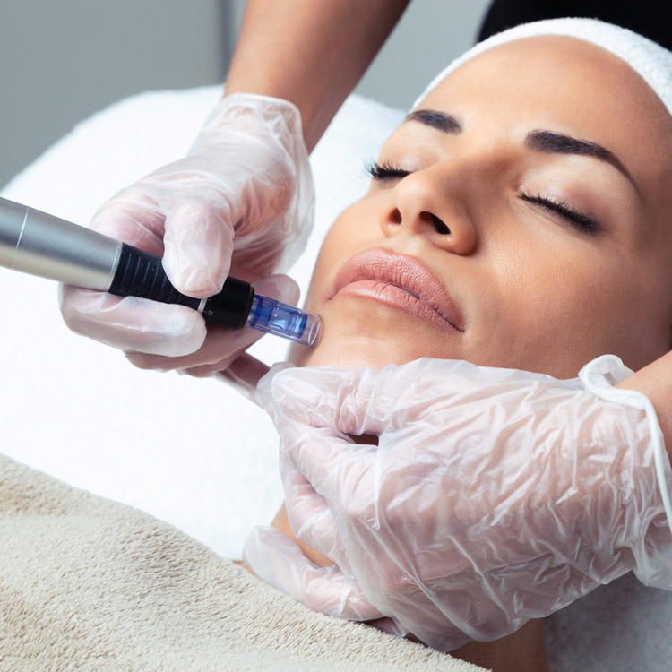 chica recibe tratamiento de dermapen labial